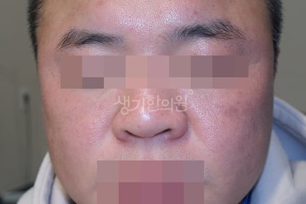안면홍조 치료 전 사진 — 천안아산점, 치료 기간 3개월