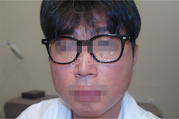 안면홍조 치료 전 사진 — 천안아산점, 치료 기간 4개월