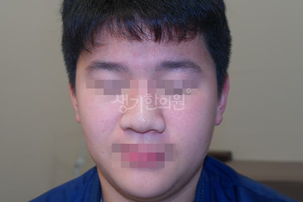 안면홍조 치료 전 사진 — 천안아산점, 치료 기간 4개월