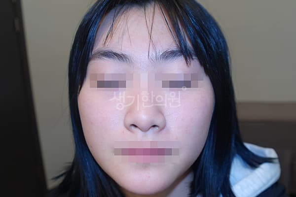 안면홍조 치료 전 사진 — 천안아산점, 치료 기간 3개월