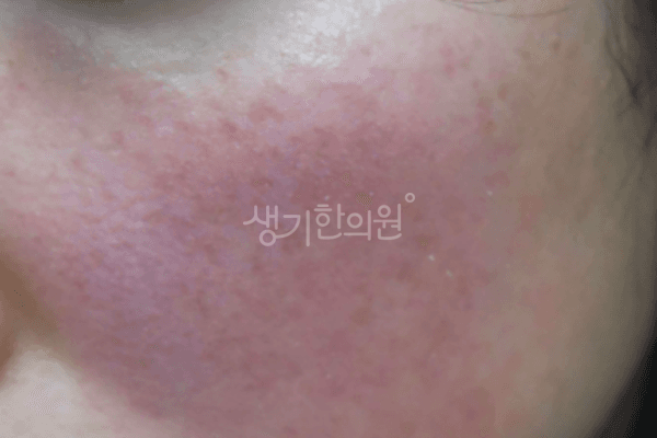 안면홍조 치료 전 사진 — 대전점, 치료 기간 6개월