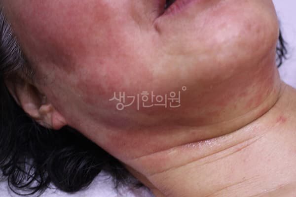 안면홍조 치료 전 사진 — 인천점, 치료 기간 4개월