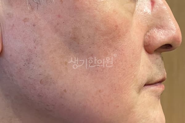 안면홍조 치료 전 사진 — 잠실점, 치료 기간 3개월