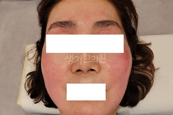 안면홍조 치료 전 사진 — 마포공덕점, 치료 기간 3개월