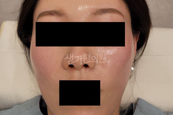 안면홍조 치료 전 사진 — 마포공덕점, 치료 기간 3개월