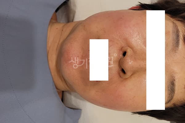안면홍조 치료 전 사진 — 마포공덕점, 치료 기간 3개월