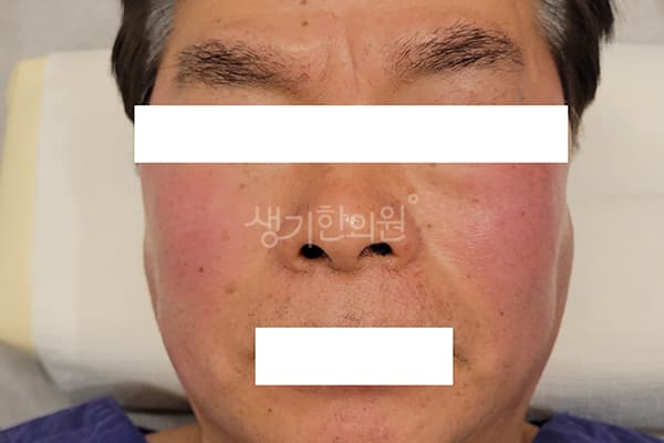 안면홍조 치료 전 사진 — 마포공덕점, 치료 기간 3개월