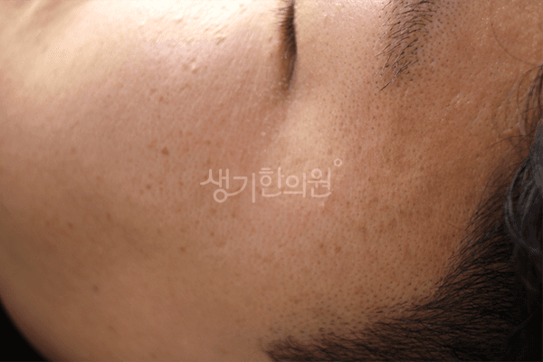 편평사마귀 치료 전 사진 — 안산점, 치료 기간 4개월