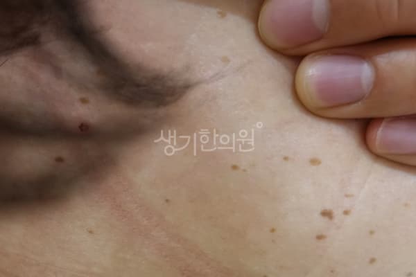 편평사마귀 치료 전 사진 — 부천점, 치료 기간 7개월
