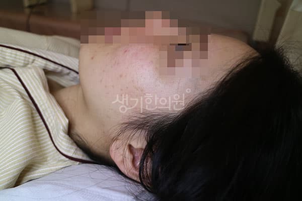편평사마귀 치료 전 사진 — 분당점, 치료 기간 6개월