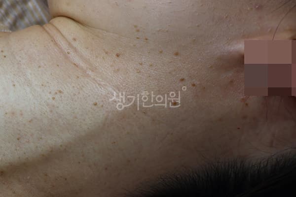 편평사마귀 치료 전 사진 — 분당점, 치료 기간 8개월