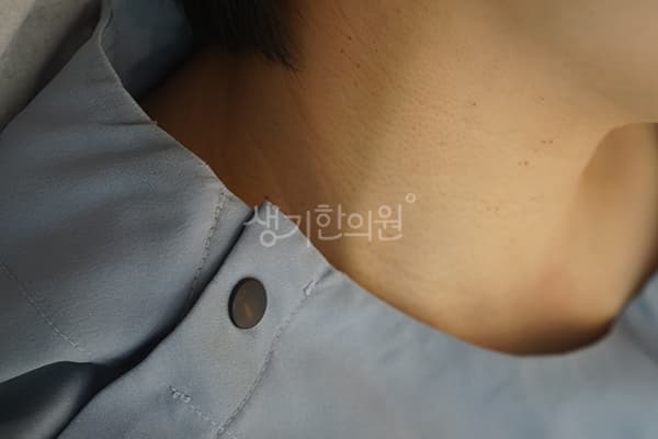편평사마귀 치료 전 사진 — 부산센텀점, 치료 기간 3개월