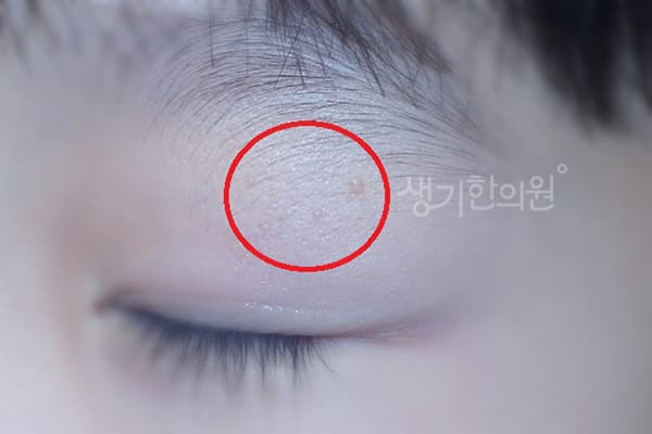 편평사마귀 치료 전 사진 — 천안아산점, 치료 기간 3개월