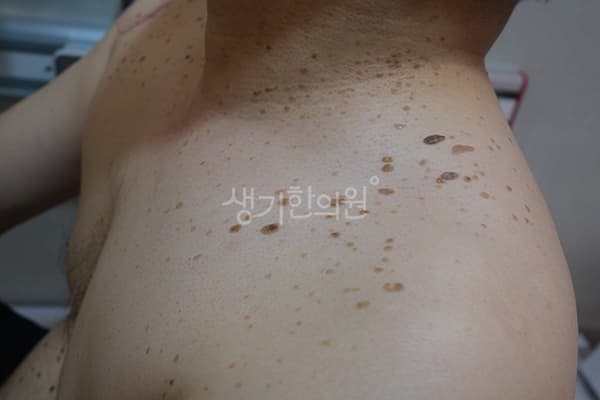 편평사마귀 치료 전 사진 — 대전점, 치료 기간 12개월