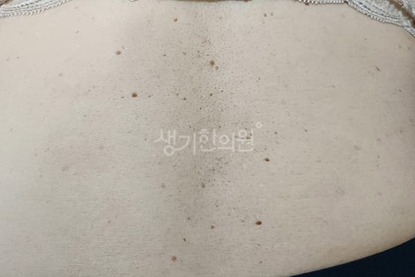 편평사마귀 치료 전 사진 — 대전점, 치료 기간 5개월