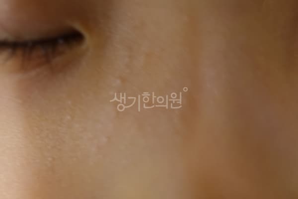 편평사마귀 치료 전 사진 — 광주점, 치료 기간 4개월