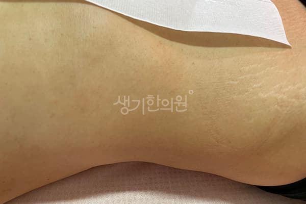 편평사마귀 치료 전 사진 — 잠실점, 치료 기간 5개월