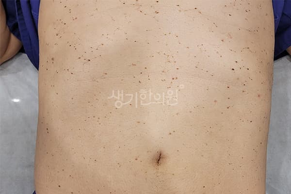 편평사마귀 치료 전 사진 — 마포공덕점, 치료 기간 9개월