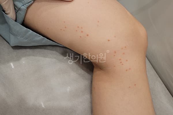 편평사마귀 치료 전 사진 — 마포공덕점, 치료 기간 4개월