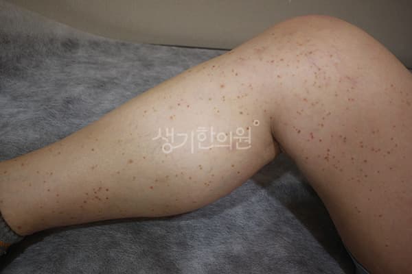 편평사마귀 치료 전 사진 — 수원점, 치료 기간 6개월