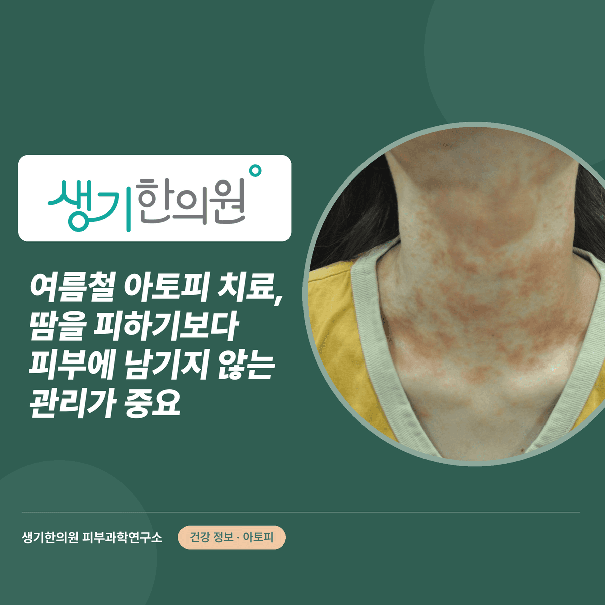 여름철 아토피 치료, 땀을 피하기보다 피부에 남기지 않는 관리가 중요 대표 이미지