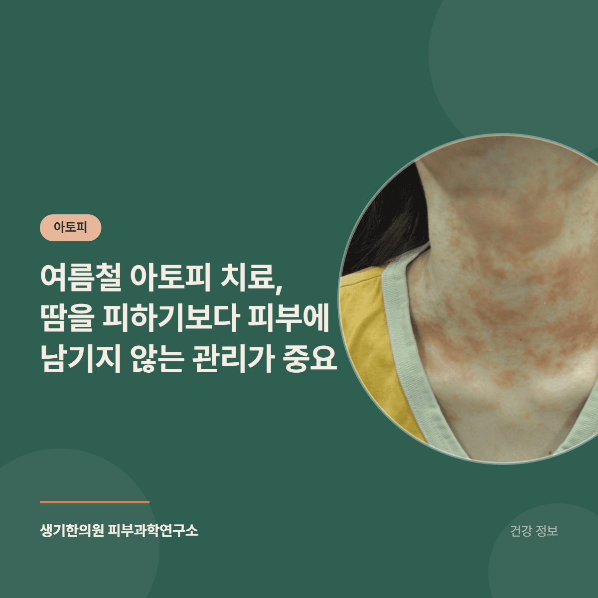 여름철 아토피 치료, 땀을 피하기보다 피부에 남기지 않는 관리가 중요 대표 이미지