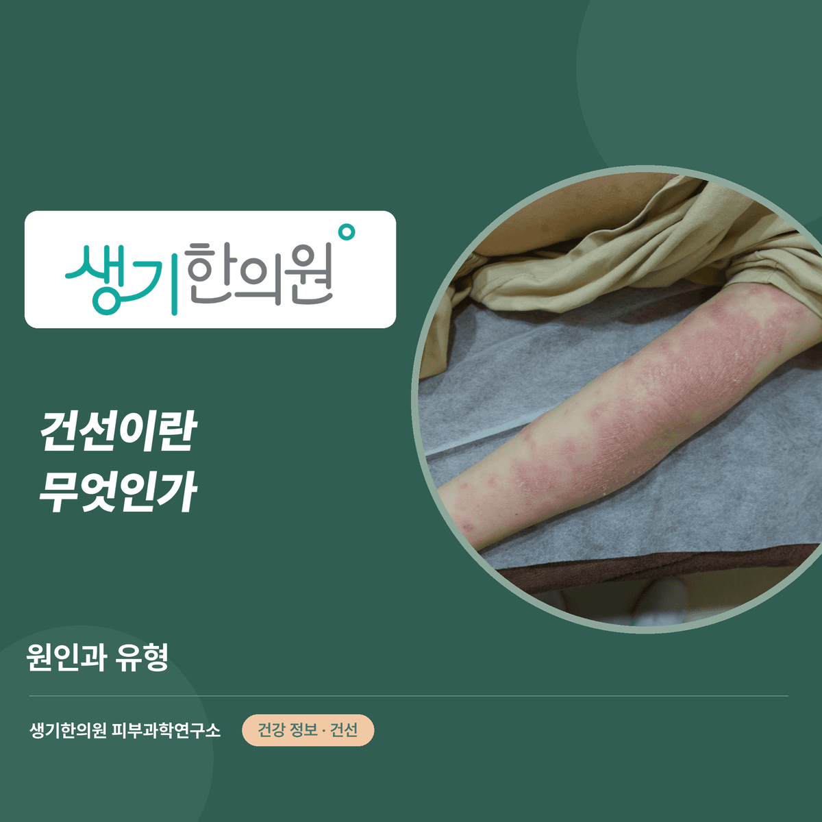 건선이란 무엇인가 — 원인과 유형 대표 이미지