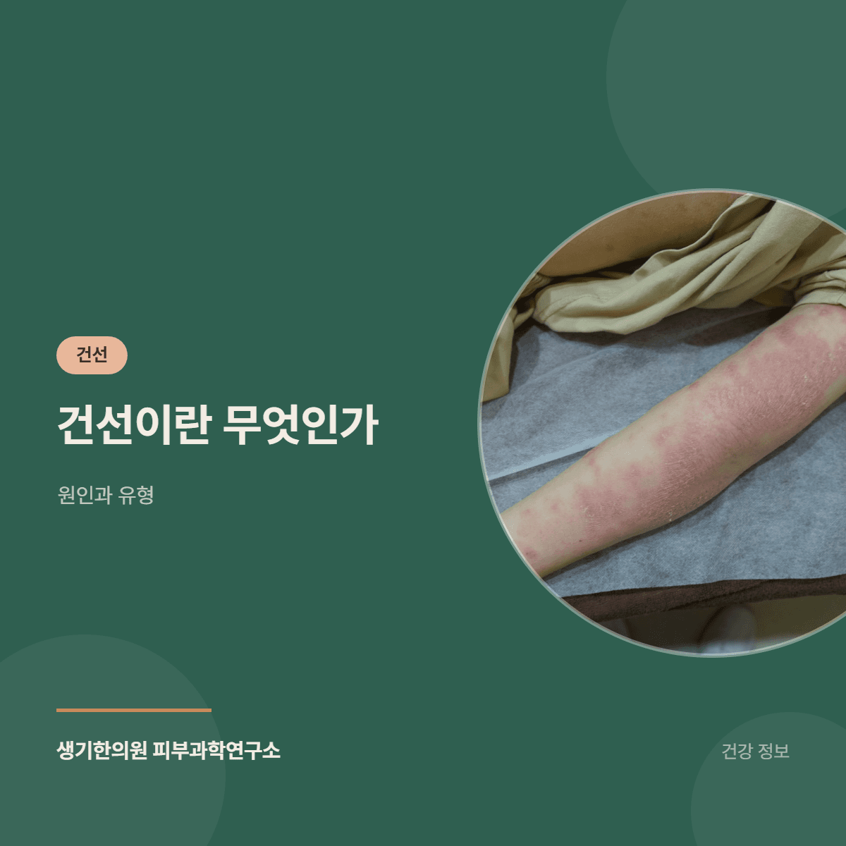 건선이란 무엇인가 — 원인과 유형 대표 이미지
