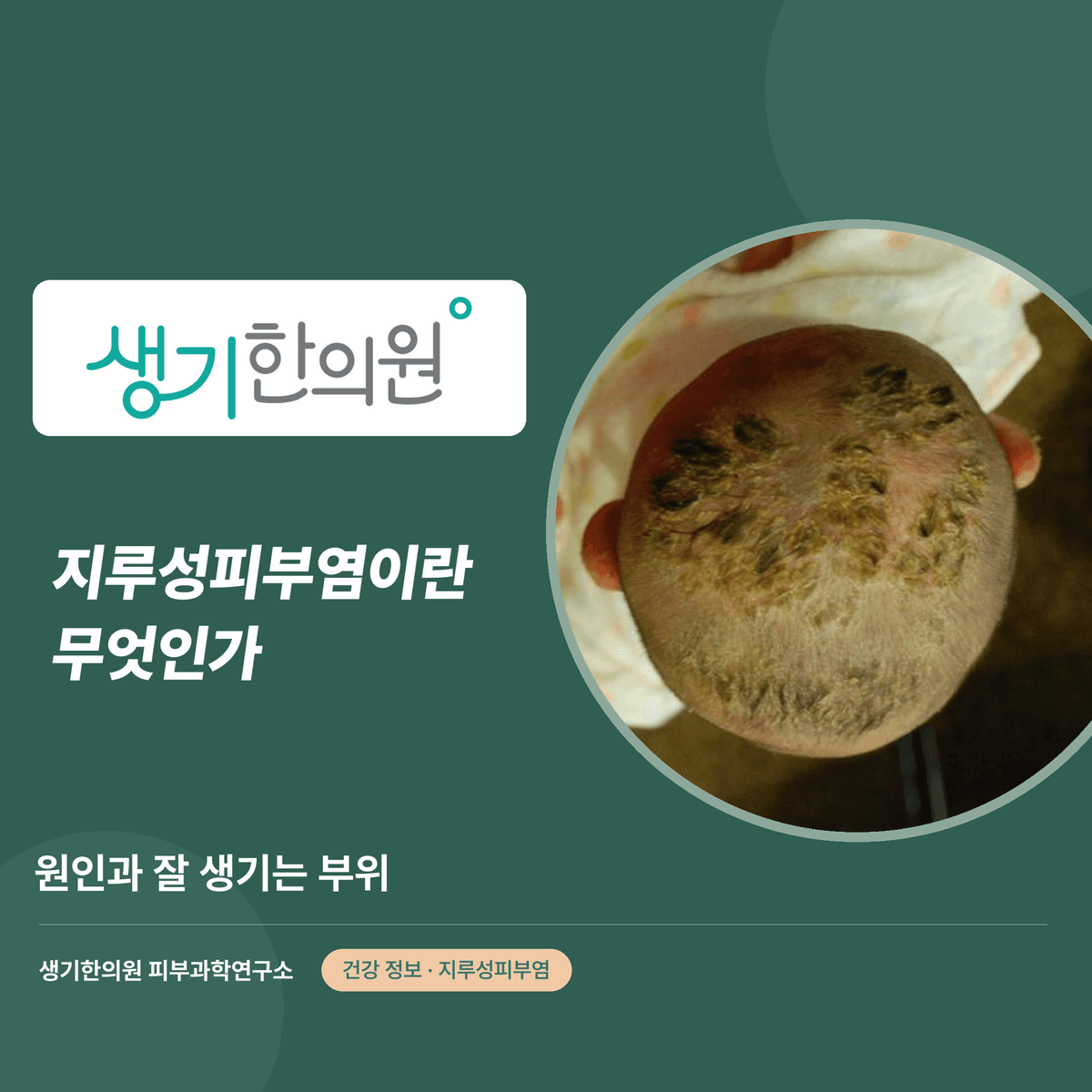 지루성피부염이란 무엇인가 — 원인과 잘 생기는 부위 대표 이미지