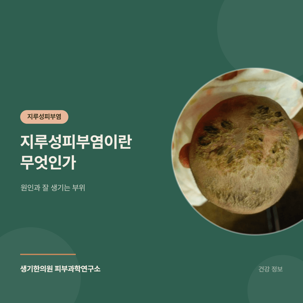 지루성피부염이란 무엇인가 — 원인과 잘 생기는 부위 대표 이미지