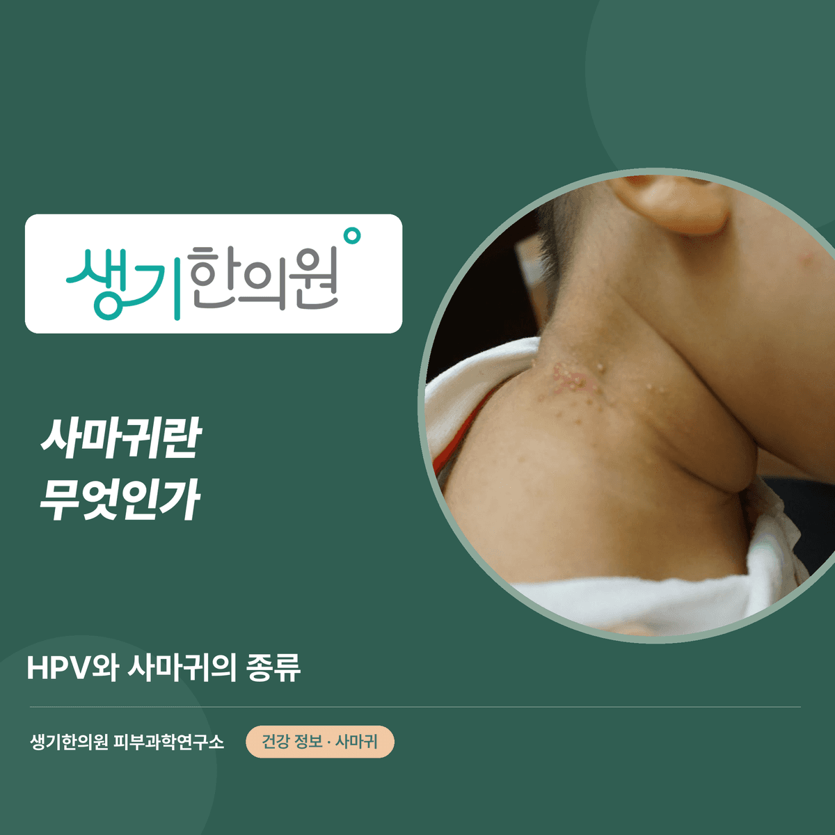 사마귀란 무엇인가 — HPV와 사마귀의 종류 대표 이미지