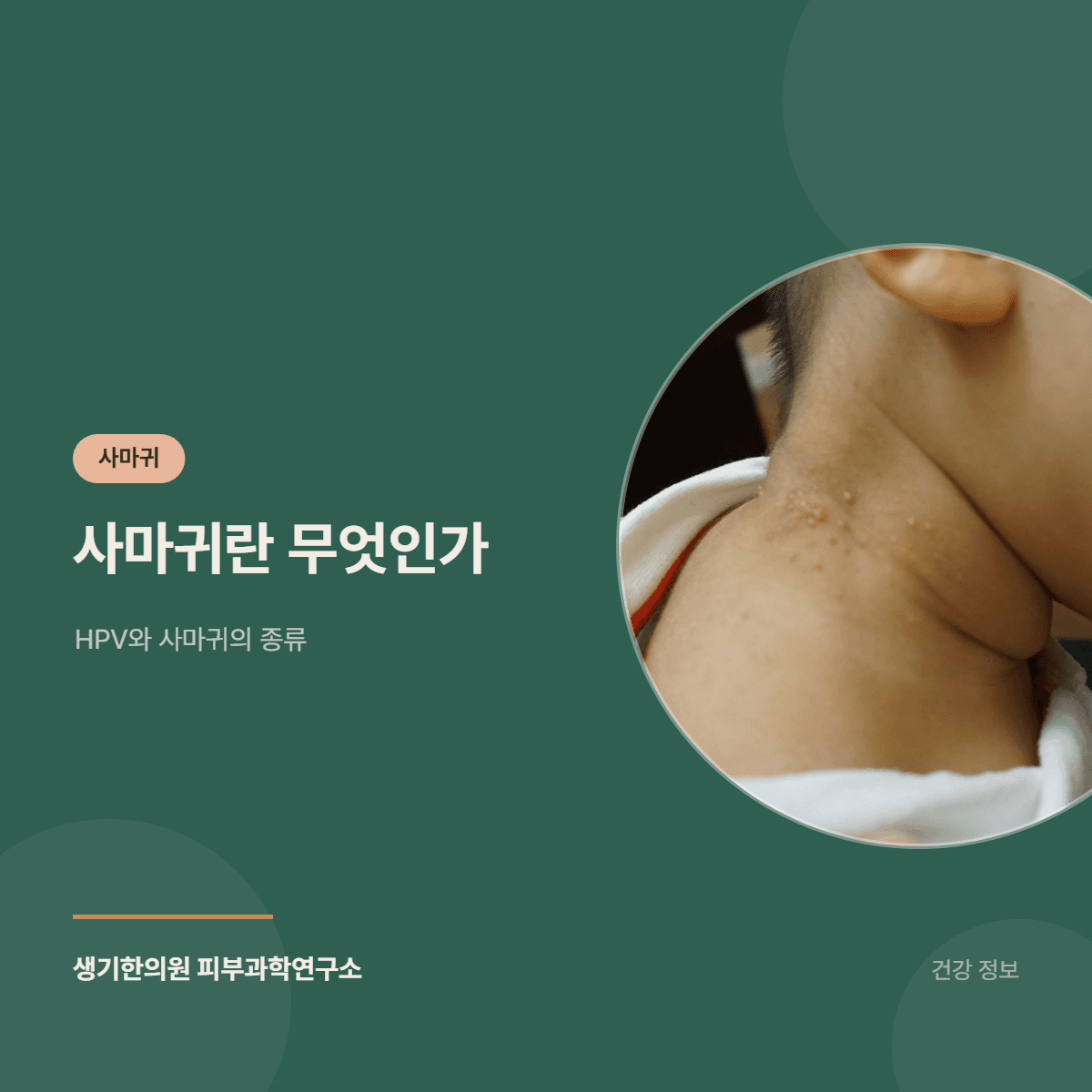 사마귀란 무엇인가 — HPV와 사마귀의 종류 대표 이미지