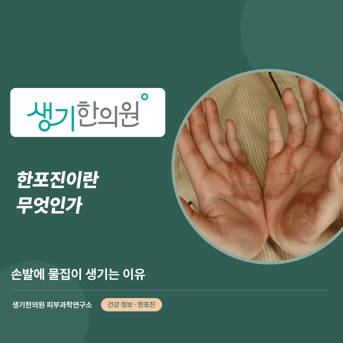 한포진이란 무엇인가 — 손발에 물집이 생기는 이유 대표 이미지