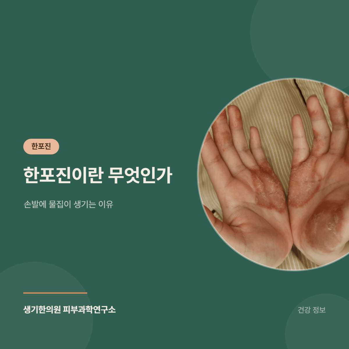 한포진이란 무엇인가 — 손발에 물집이 생기는 이유 대표 이미지
