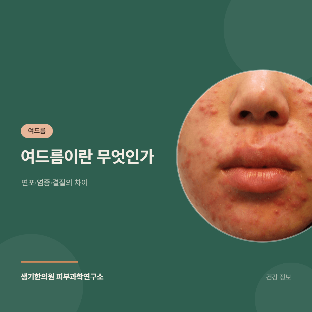 여드름이란 무엇인가 — 면포·염증·결절의 차이 대표 이미지