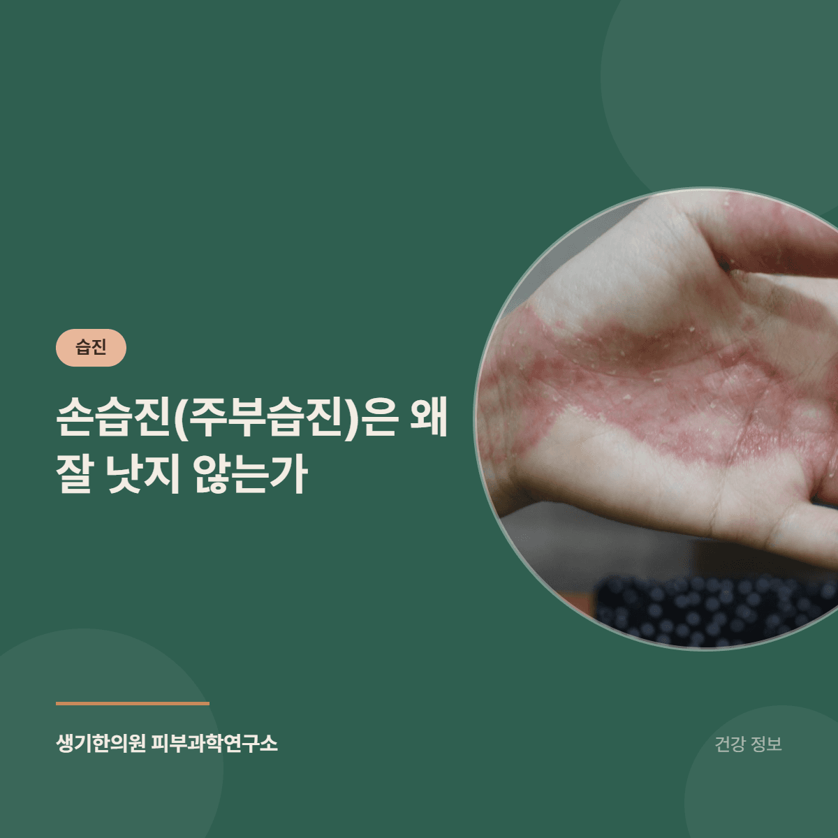 손습진(주부습진)은 왜 잘 낫지 않는가 대표 이미지
