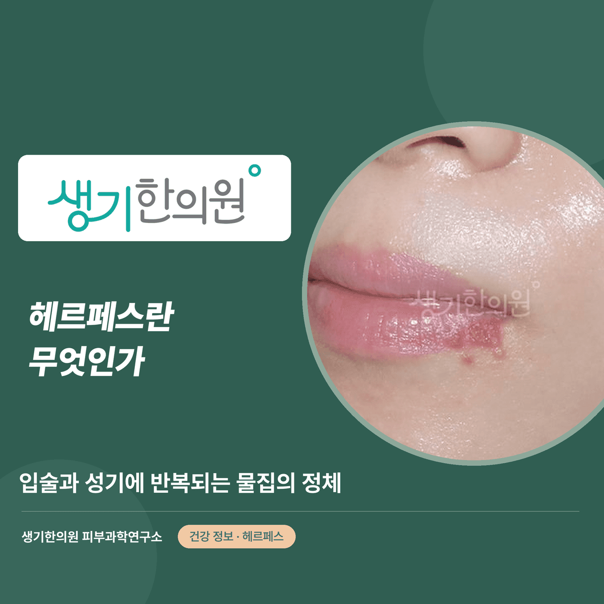 헤르페스란 무엇인가 — 입술과 성기에 반복되는 물집의 정체 대표 이미지