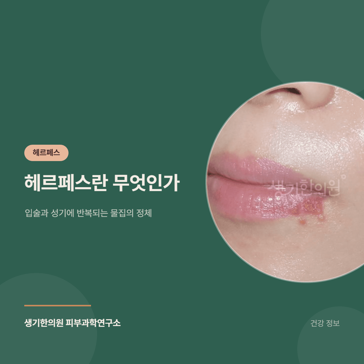 헤르페스란 무엇인가 — 입술과 성기에 반복되는 물집의 정체 대표 이미지