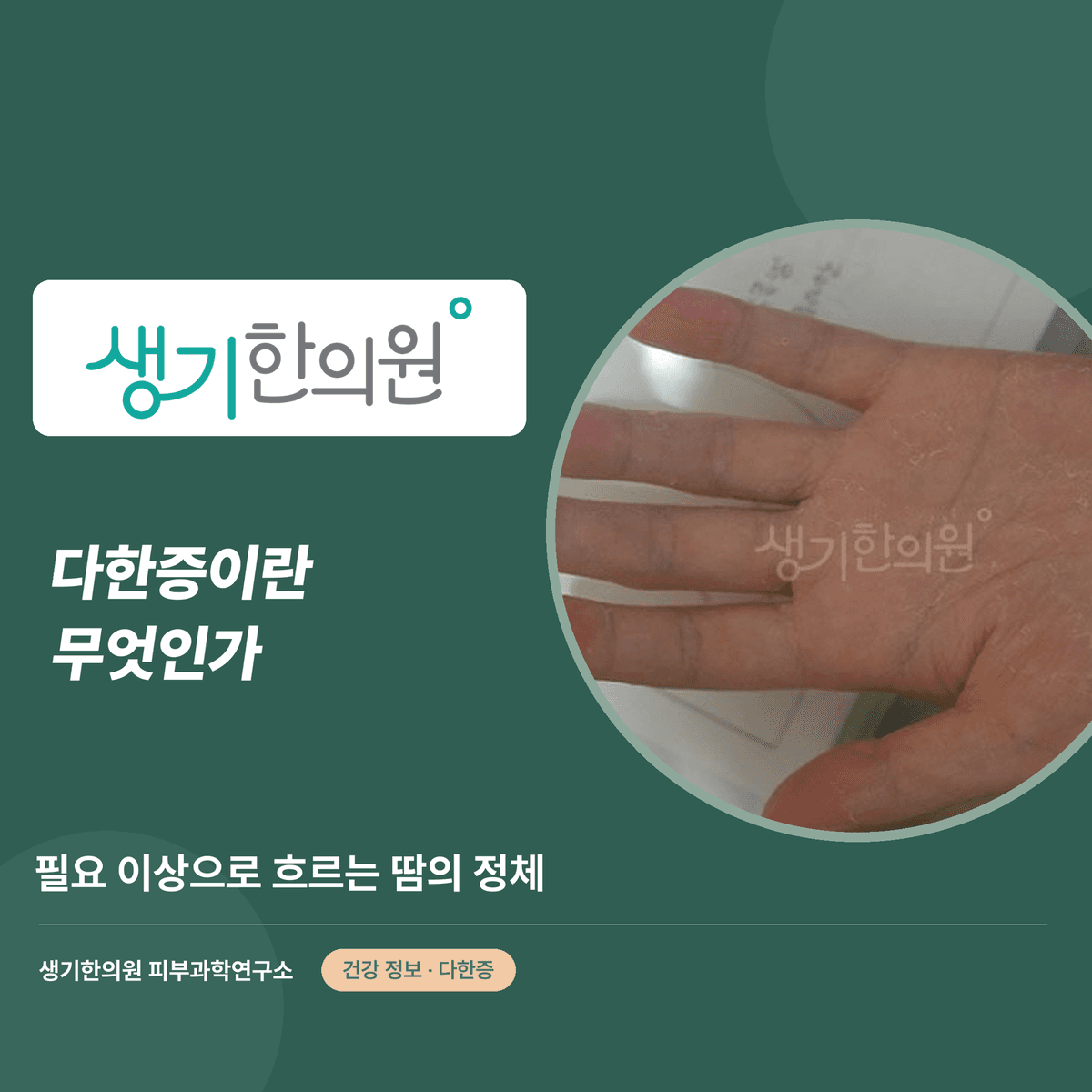 다한증이란 무엇인가 — 필요 이상으로 흐르는 땀의 정체 대표 이미지