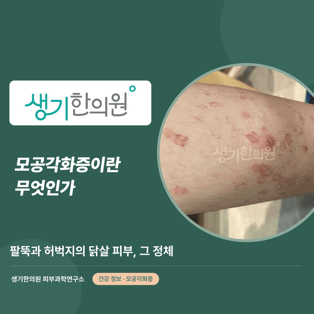 모공각화증이란 무엇인가 — 팔뚝과 허벅지의 닭살 피부, 그 정체 대표 이미지