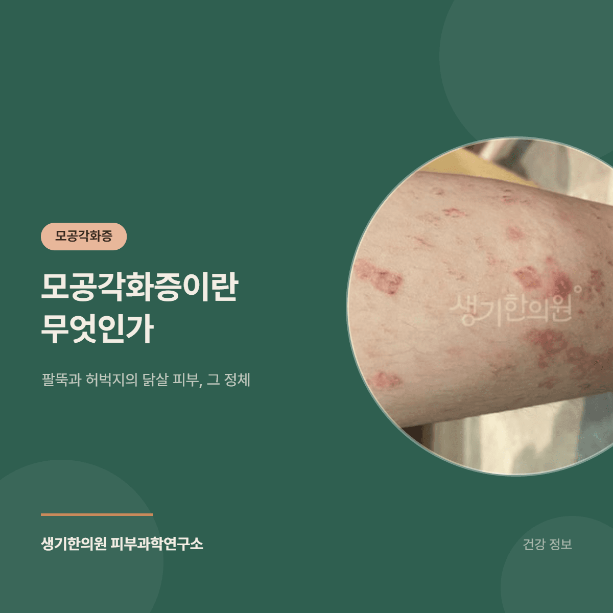 모공각화증이란 무엇인가 — 팔뚝과 허벅지의 닭살 피부, 그 정체 대표 이미지