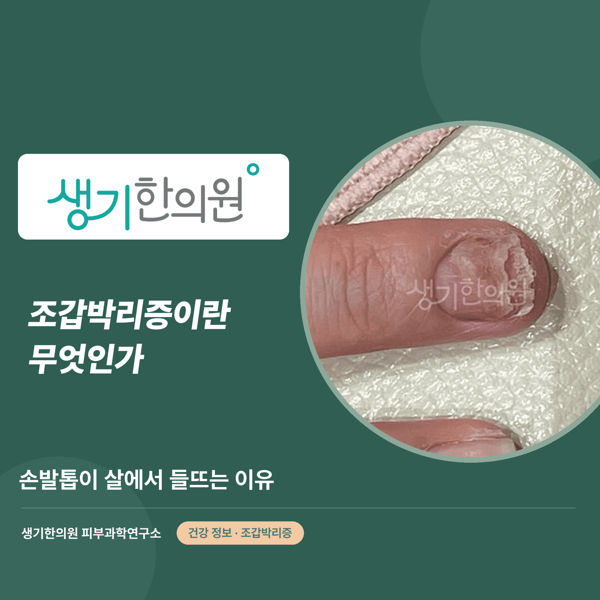 조갑박리증이란 무엇인가 — 손발톱이 살에서 들뜨는 이유 대표 이미지