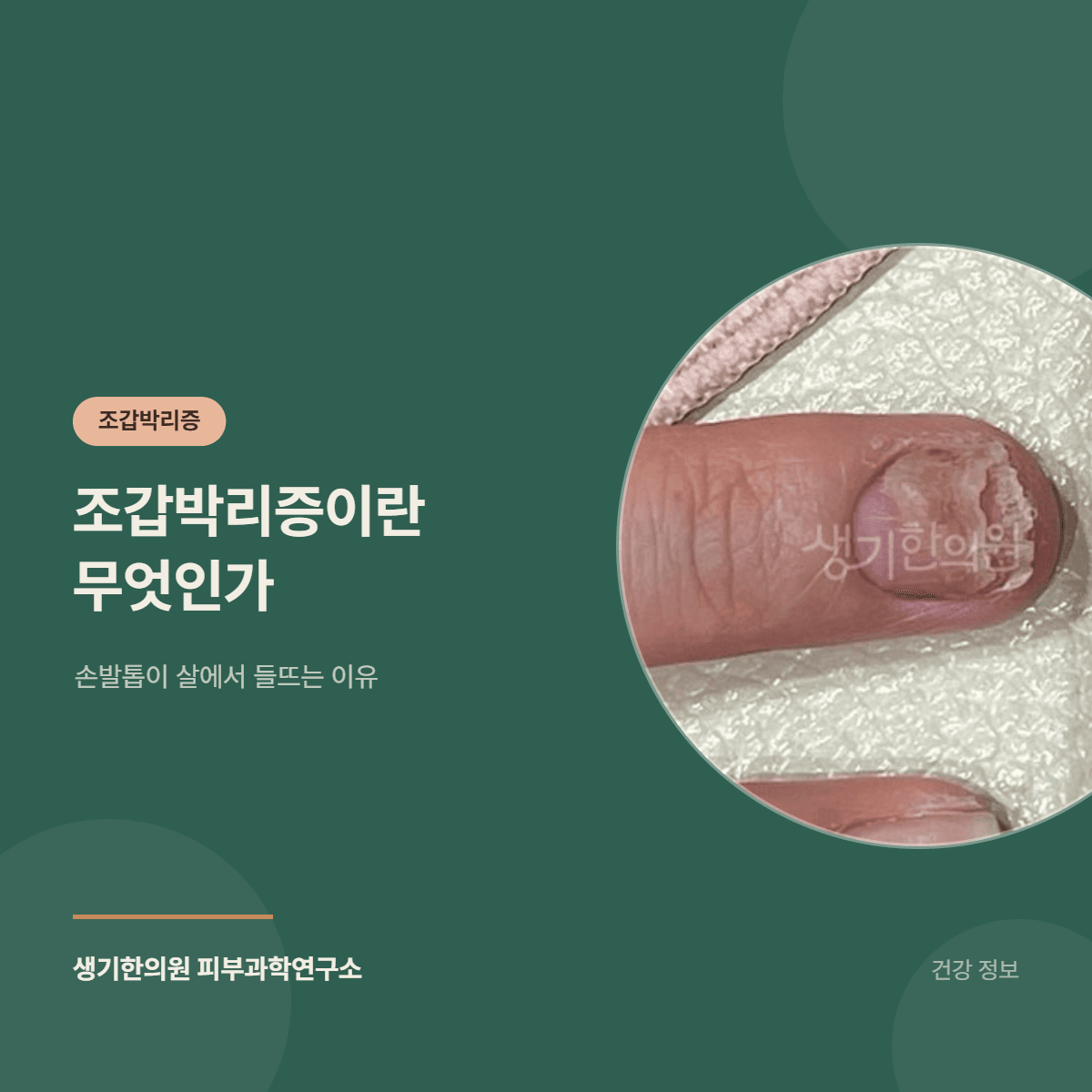 조갑박리증이란 무엇인가 — 손발톱이 살에서 들뜨는 이유 대표 이미지