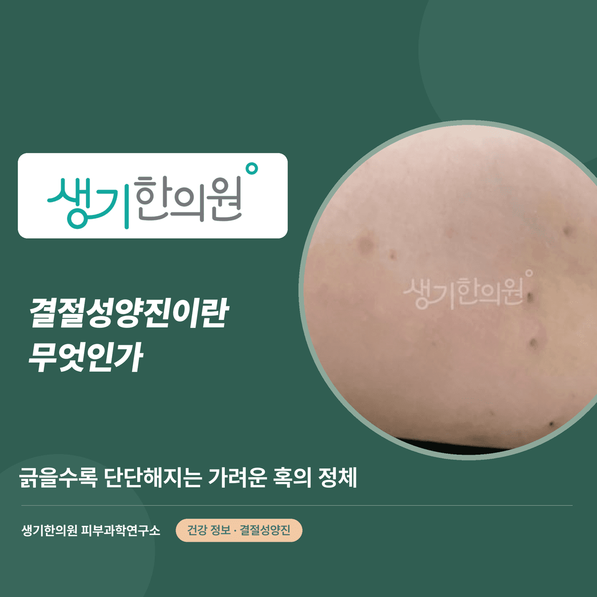 결절성양진이란 무엇인가 — 긁을수록 단단해지는 가려운 혹의 정체 대표 이미지