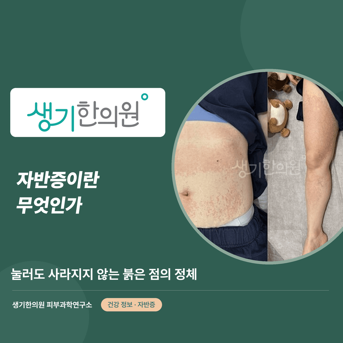 자반증이란 무엇인가 — 눌러도 사라지지 않는 붉은 점의 정체 대표 이미지