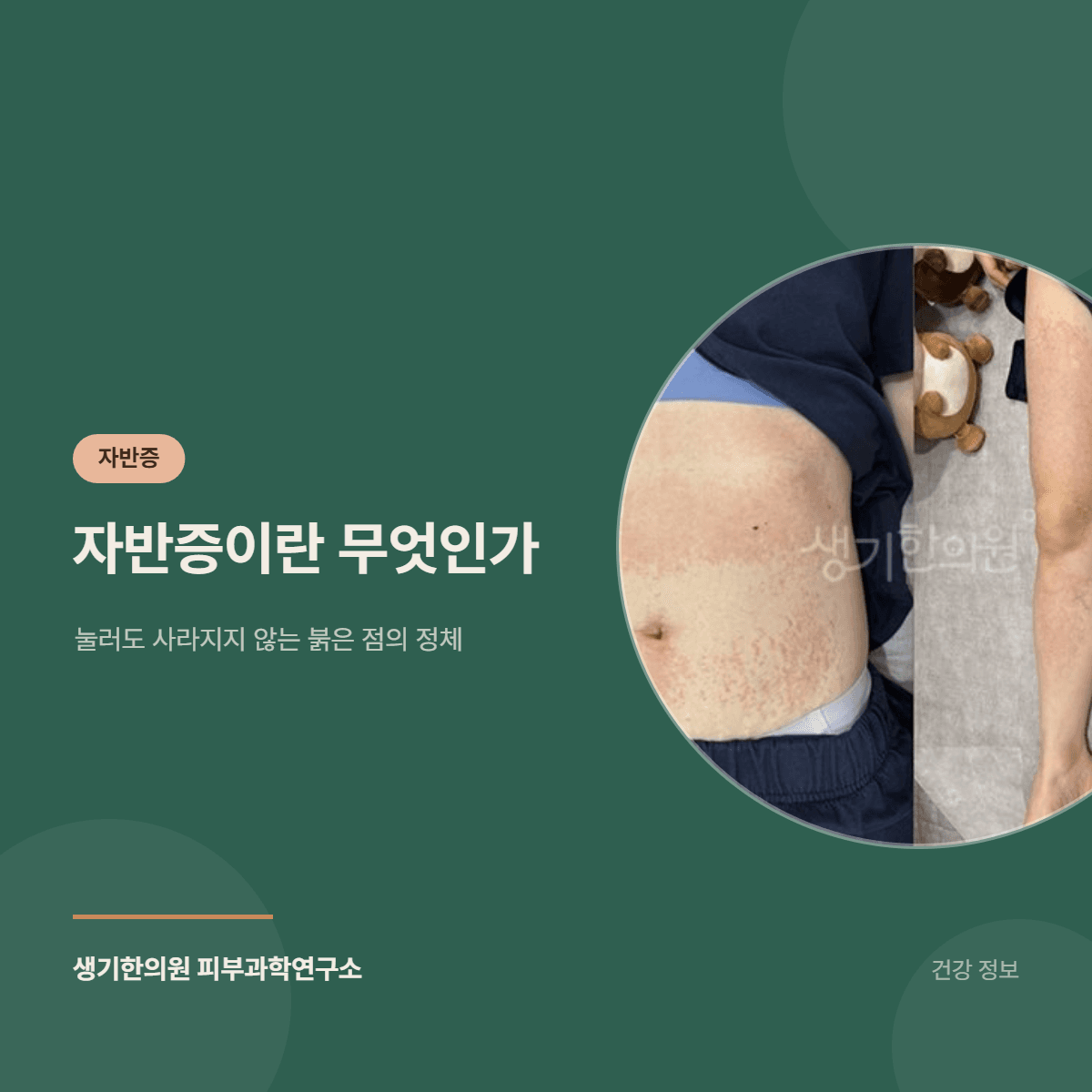 자반증이란 무엇인가 — 눌러도 사라지지 않는 붉은 점의 정체 대표 이미지