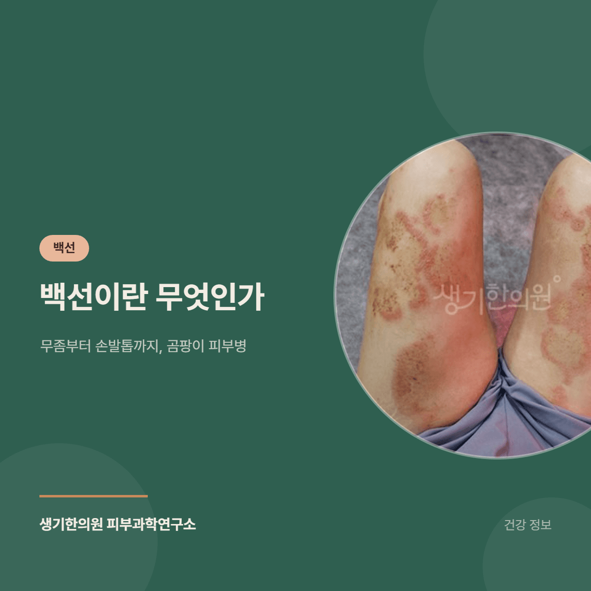 백선이란 무엇인가 — 무좀부터 손발톱까지, 곰팡이 피부병 대표 이미지