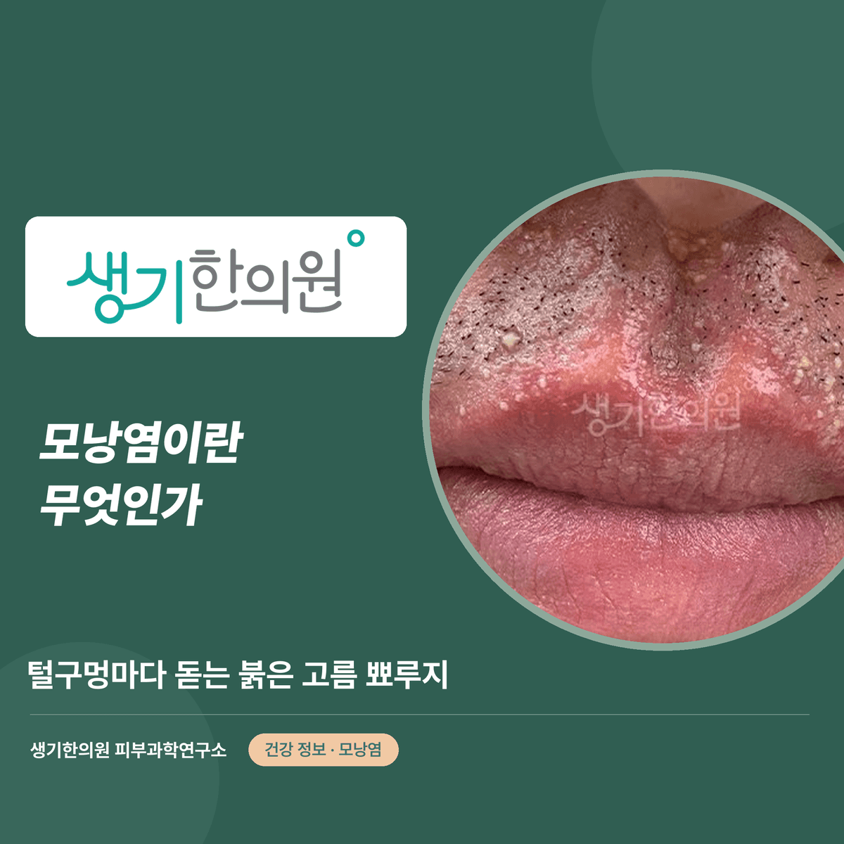 모낭염이란 무엇인가 — 털구멍마다 돋는 붉은 고름 뾰루지 대표 이미지