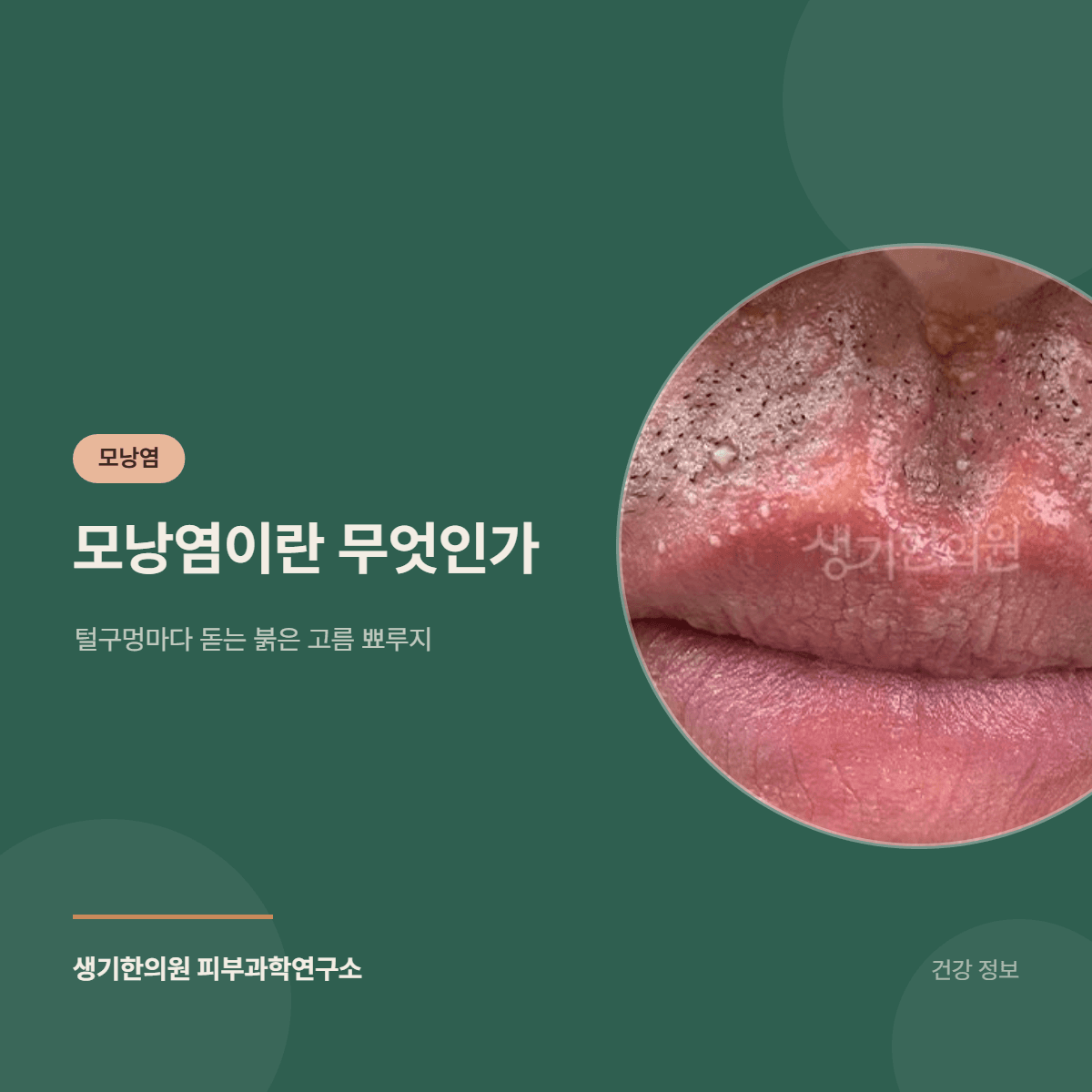모낭염이란 무엇인가 — 털구멍마다 돋는 붉은 고름 뾰루지 대표 이미지