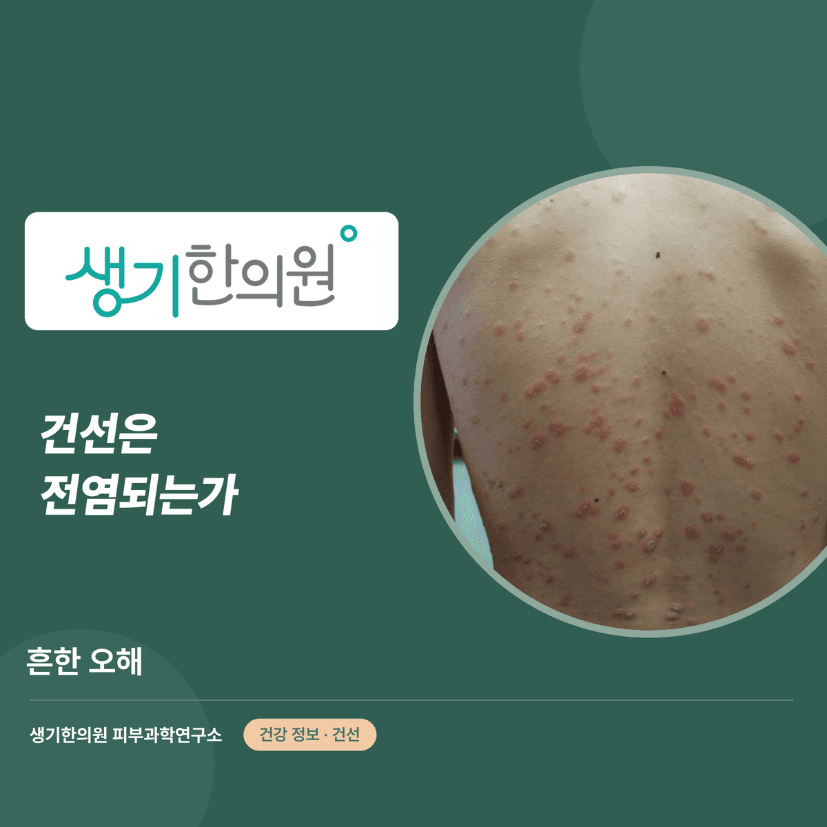 건선은 전염되는가 — 흔한 오해 대표 이미지